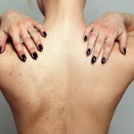 Yazın Bıraktığı Lekeler Sonbaharda Neden Geçmiyor?