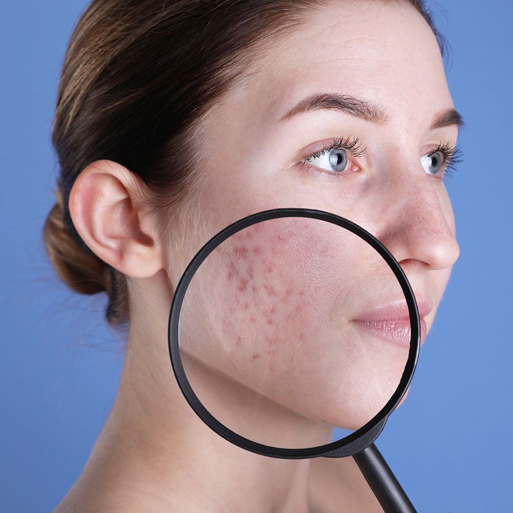 Akne Bakımı Uygulamaları