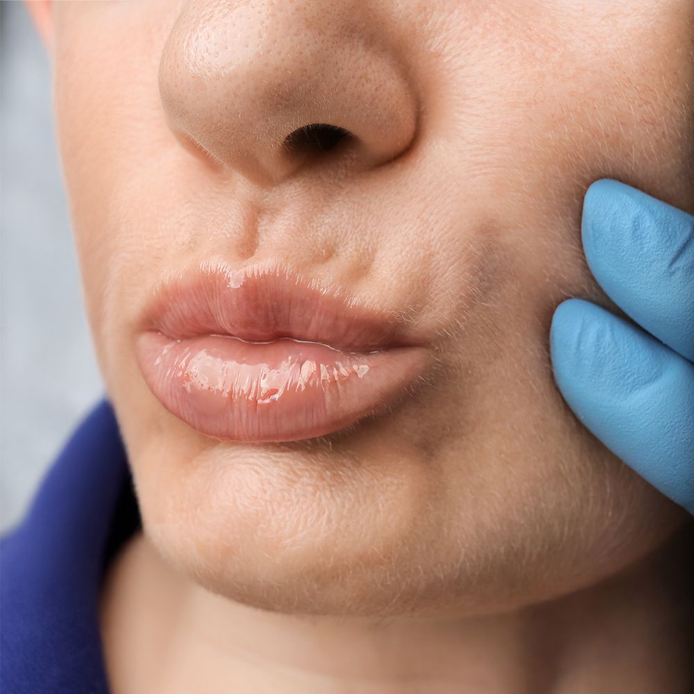 Dudak Üstü Çizgiler Dolgusu