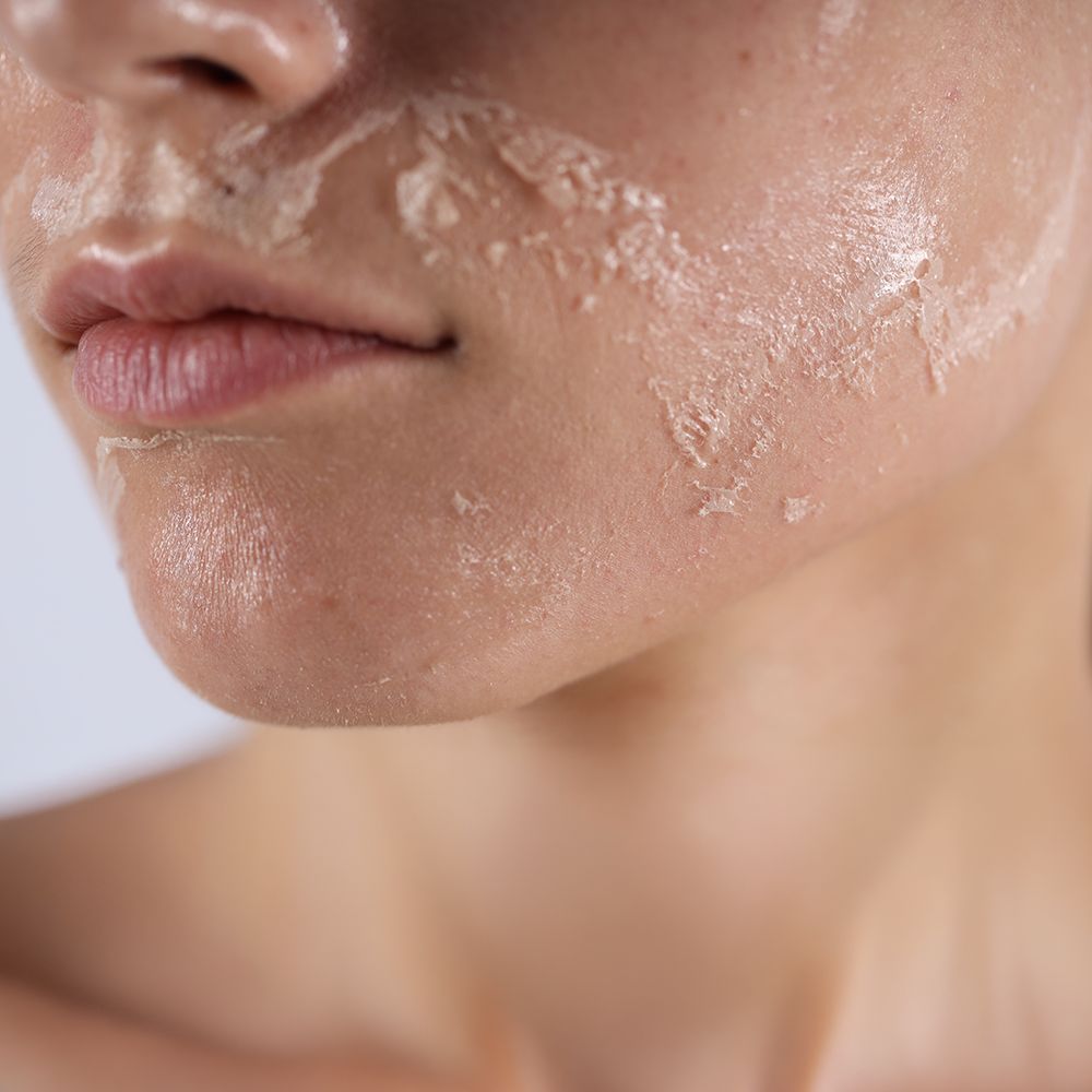 Fenol Peelling Uygulamaları