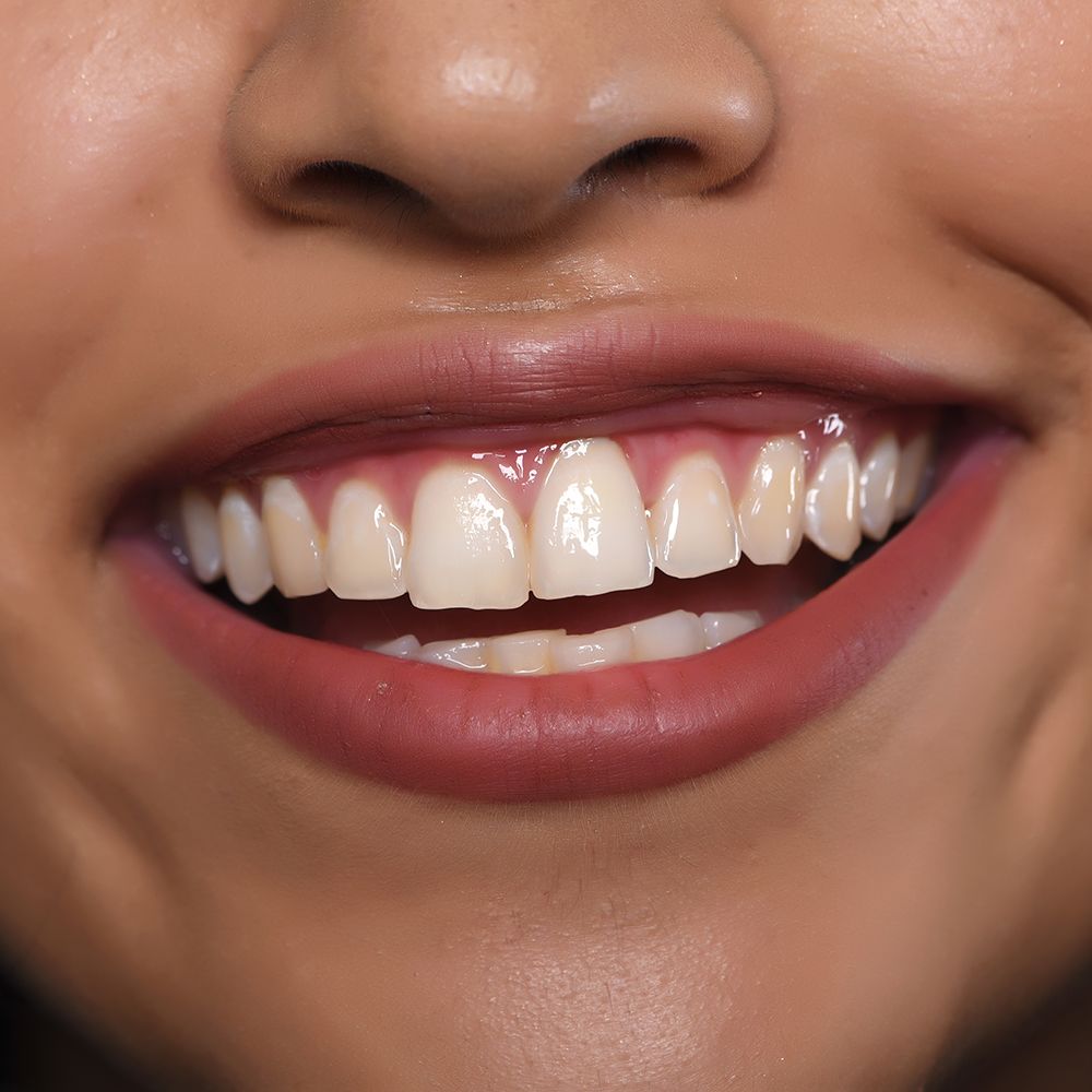 Gummy Smile Botoksu (Diş Eti)