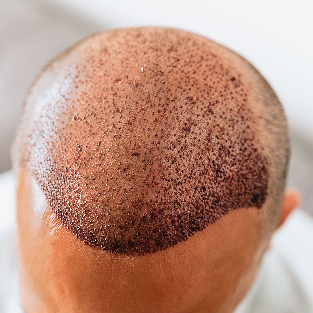 Saç Ekimi ve Tedavi Uygulamaları