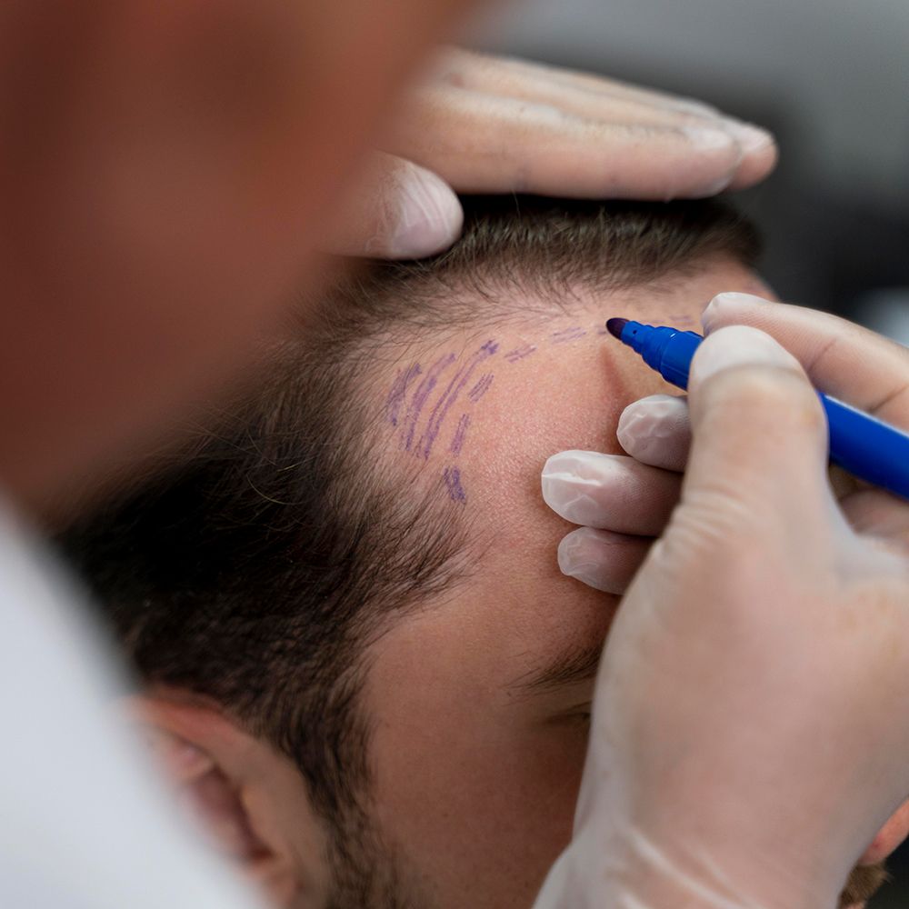 Saç Ekimi Uygulamaları