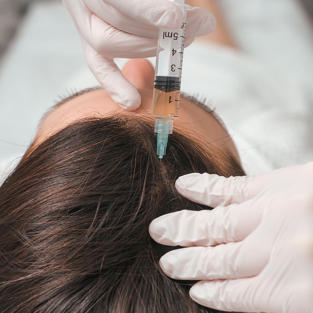 Saç Mezoterapi Uygulamaları