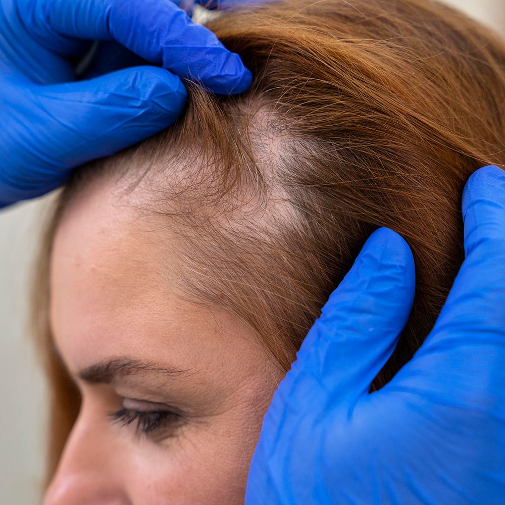 Saç PRP Uygulamaları