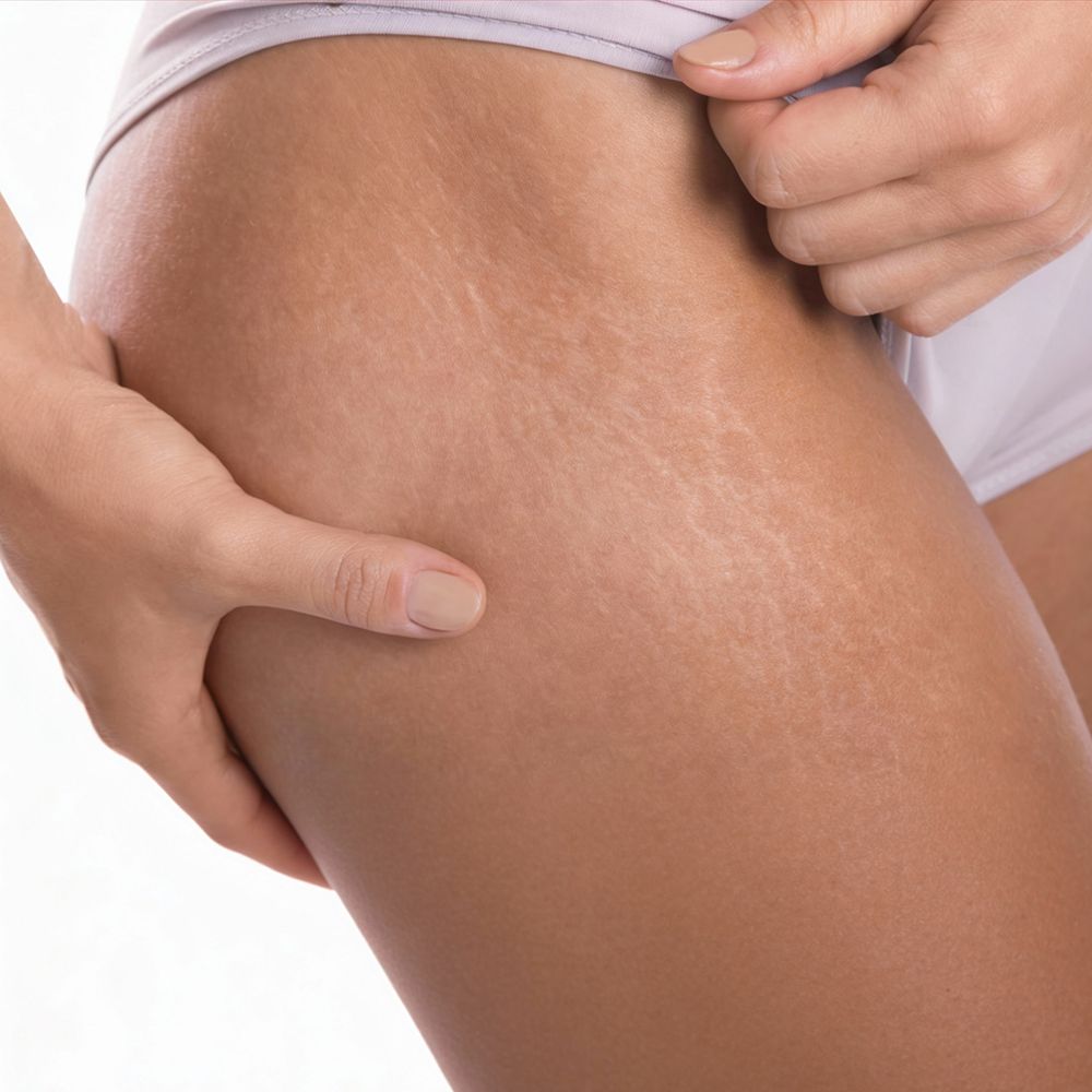 Stria (Çatlak) Mezoterapi