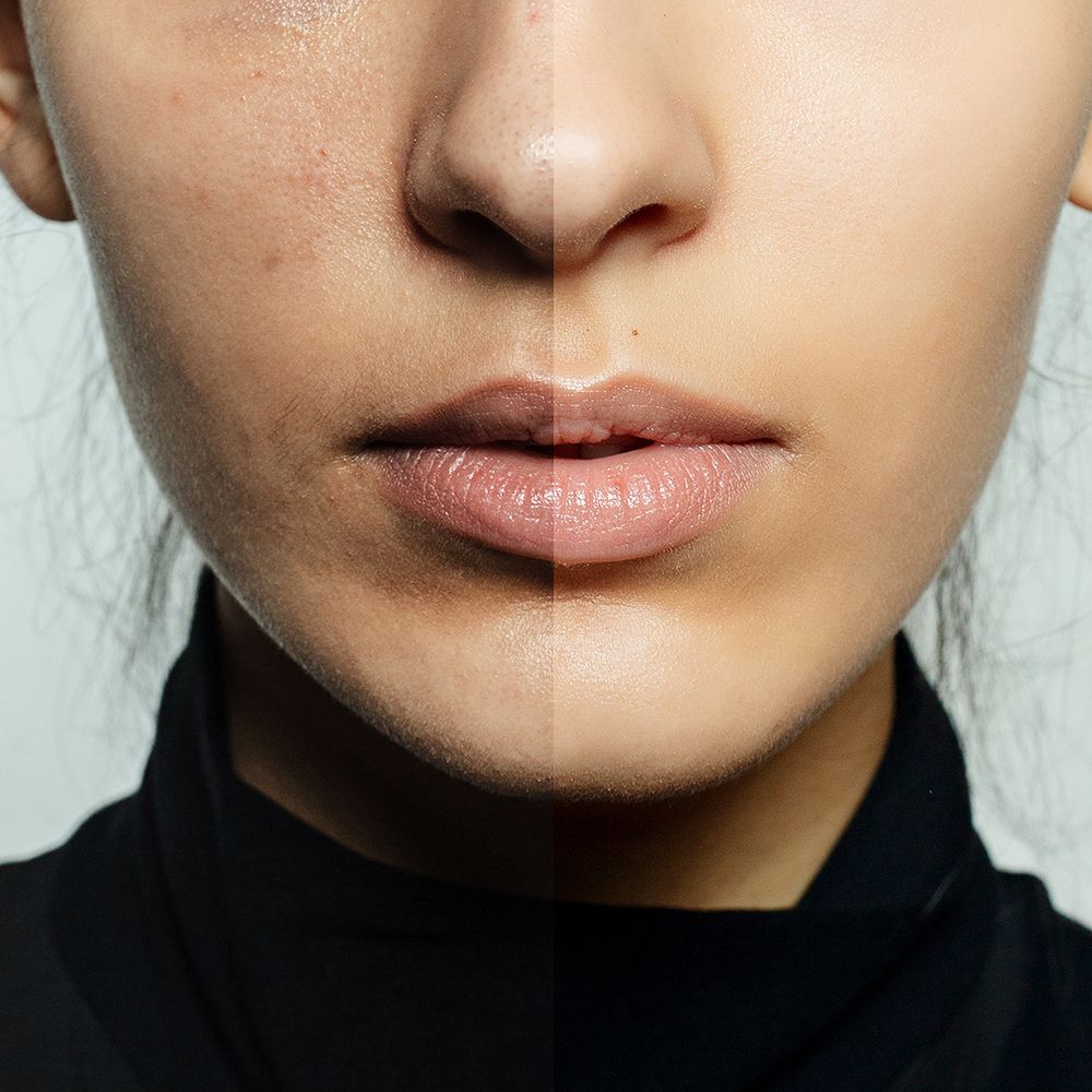 TCA Peelling Uygulamaları