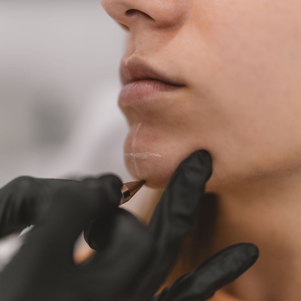 Tek Bölge (Çene) Botoksu